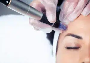 Microneedling Treatment in Essex