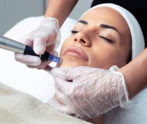 SkinPen Microneedling Treatment in Epping