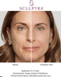 Sculptra before and after results showing improved skin firmness at Epping aesthetics clinic