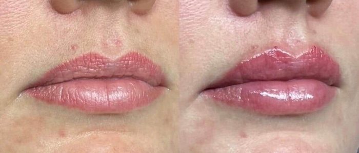 Lip filler before and after results at aesthetics clinic in Epping, Essex
