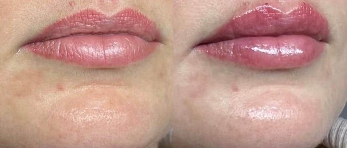 Lip filler before and after results at aesthetics clinic in Epping, Essex