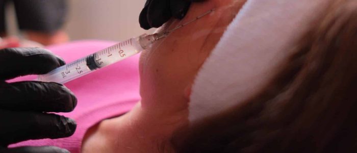 Practitioner administering Sculptra injection to jawline at aesthetics clinic in Epping, Essex