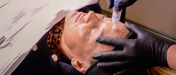 SkinPen microneedling treatment on forehead at aesthetics clinic in Epping, Essex